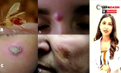 Dermatoloji Uzmanı Melis Bal Akdoğan’dan Şanlıurfa’da Şark Çıbanı Uyarısı
