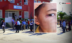 Şanlıurfa'da Okulda Çocuğun Yüzünde Sigara Söndürüldüğü İddiası