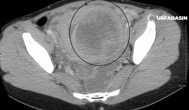 Şanlıurfa'da Özelikle Doğum Yapan Kadınlarda Görülen Hastalık