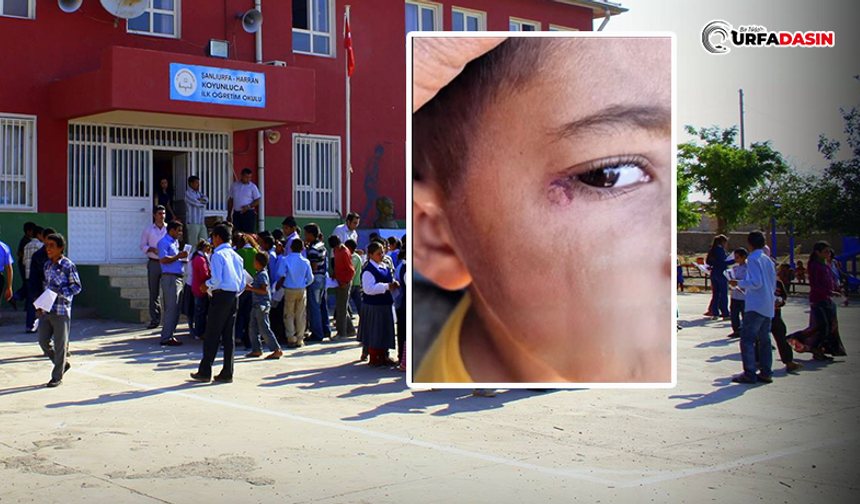 Şanlıurfa'da Okulda Çocuğun Yüzünde Sigara Söndürüldüğü İddiası